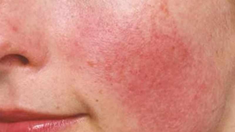 Uống nhiều collagen có thể gây ra các phản ứng dị ứng như ngứa hoặc phát ban