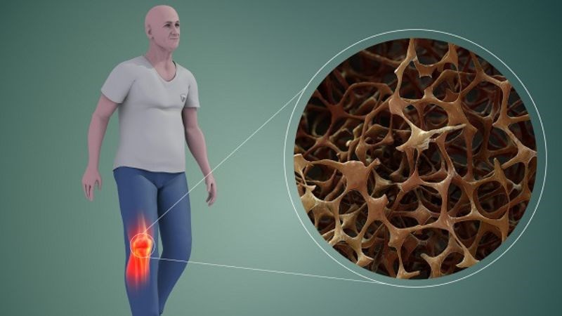 Bổ sung glucosamine có thể giúp phòng ngừa loãng xương