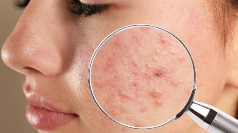 Bổ sung đủ vitamin B5 có thể cải thiện tình trạng mụn