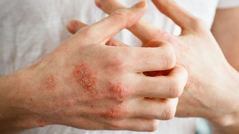 Vitamin B3 giúp cải thiện các triệu chứng bệnh Pellagra