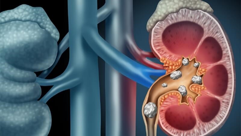 Vitamin C có thể gây sỏi thận ở liều cao kéo dài