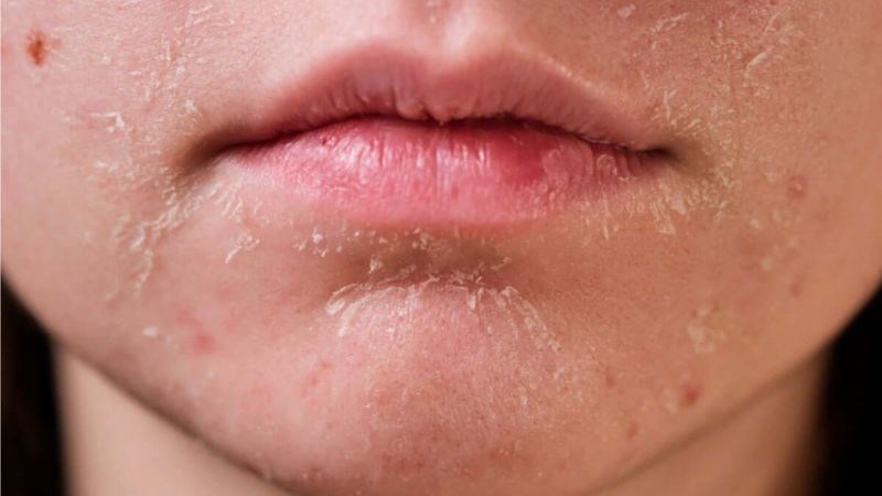 Thiếu vitamin C làm cho da trở nên sần sùi, khô ráp