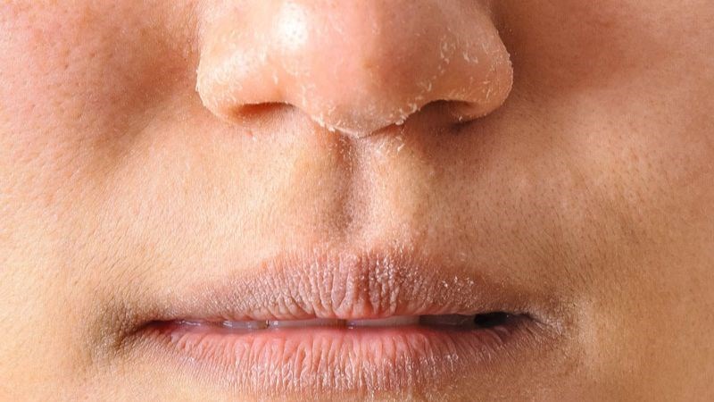 Nếu thiếu hụt vitamin C kéo dài có thể dẫn đến tình trạng khô da