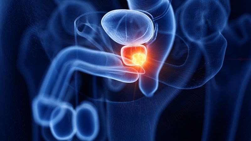EPA có tác dụng tốt trong điều trị ung thư tiền liệt tuyến