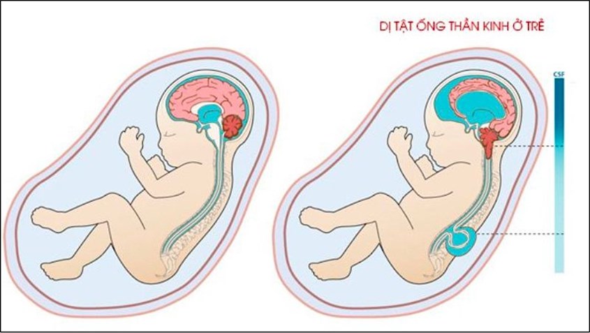 Mức acid folic thấp trong thai kỳ làm tăng nguy cơ dị tật nức đốt sống