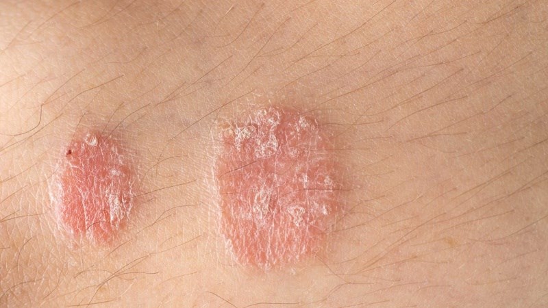 Giấm táo pha loãng có thể cải thiện tính toàn vẹn của hàng rào bảo vệ da trong viêm da dị ứng, bệnh chàm