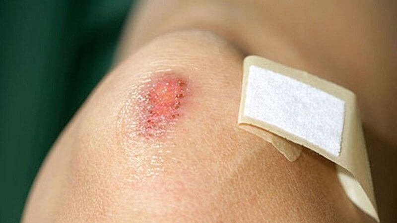 Bổ sung đủ vitamin K có thể giúp trẻ mau lành vết thương hơn Bổ sung đủ vitamin K có thể giúp trẻ mau lành vết thương hơn