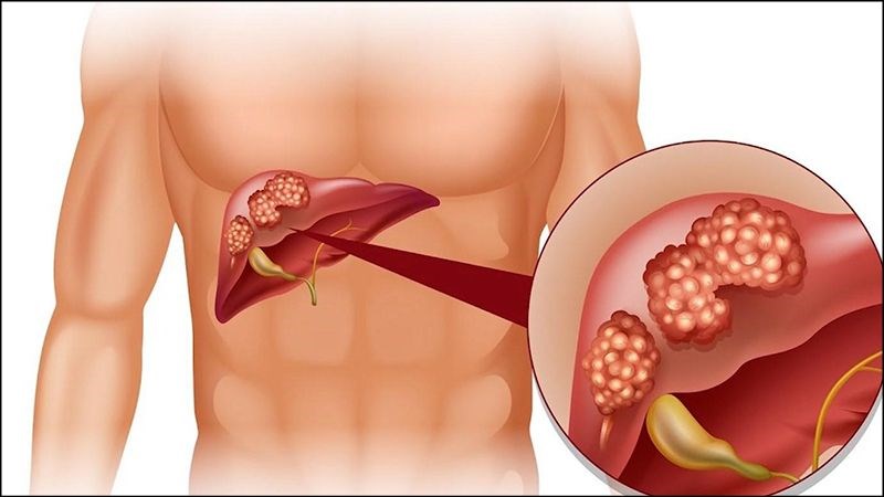 Bổ sung sắt quá nhiều có thể gây nên những ảnh hưởng tiêu cực đến gan