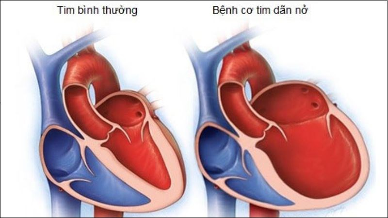 Thymomodulin có thể giúp cải thiện chức năng tim trong bệnh cơ tim giãn 