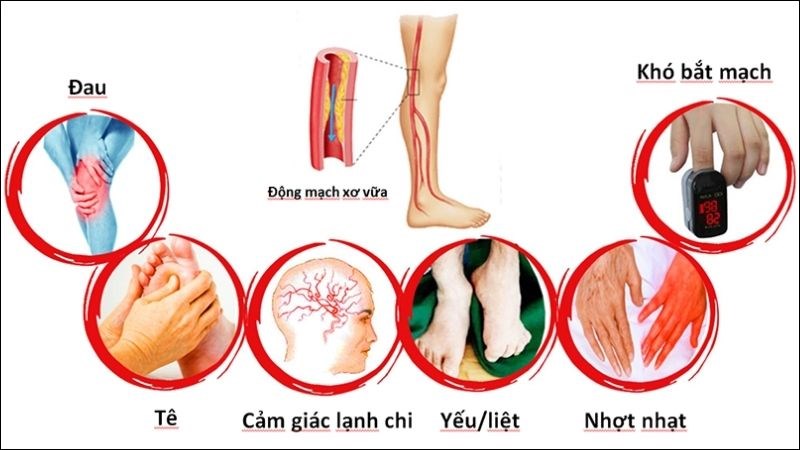 L-arginine có thể làm dịu các triệu chứng của bệnh động mạch ngoại biên