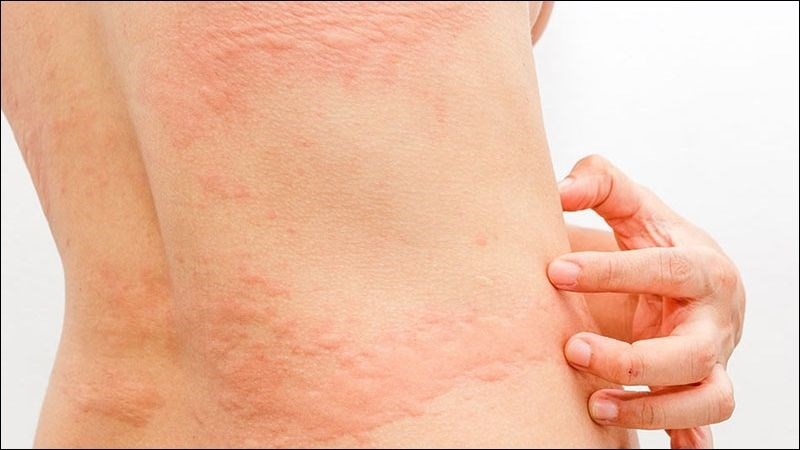 Phản ứng dị ứng có thể xảy ra do sử dụng quá mức Beta Glucan Phản ứng dị ứng có thể xảy ra do sử dụng quá mức Beta Glucan