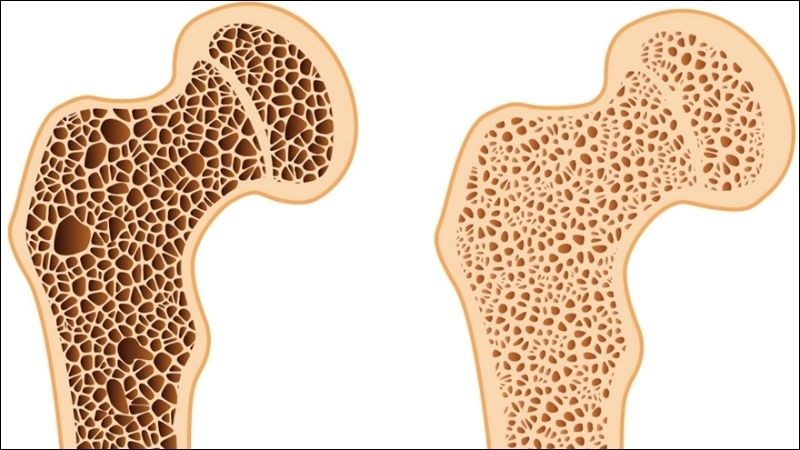 Beta Glucan kích thích tăng cường sản xuất và tái tạo mô xương Beta Glucan kích thích tăng cường sản xuất và tái tạo mô xương