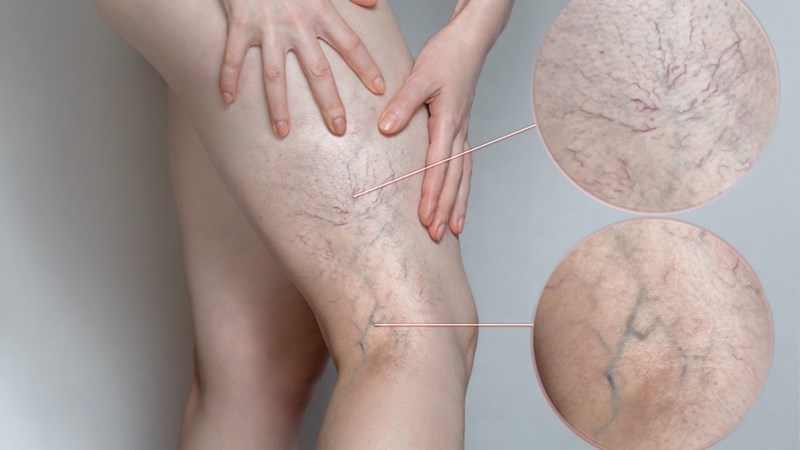 Rutin có thể cải thiện và điều trị tình trạng bệnh lý suy tĩnh mạch mạn tính
