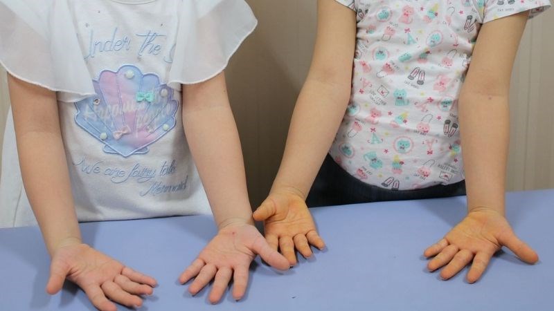 Sử dụng quá liều Lutein có thể gây nên vàng da