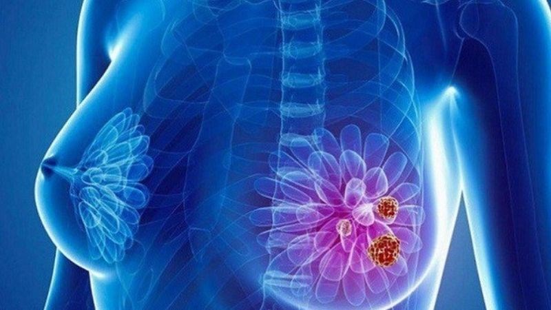 Tiêu thụ nhiều choline có thể làm giảm nguy cơ mắc ung thư vú
