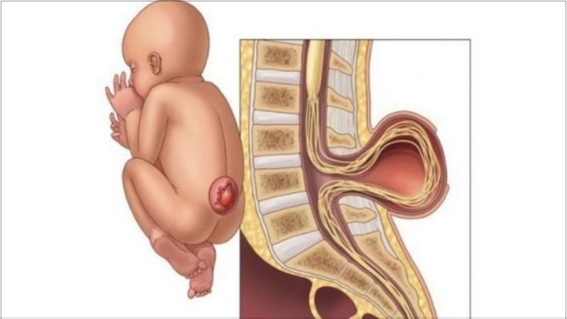 Mẹ cần cung cấp đủ choline để ngăn ngừa tình trạng dị tật ống thần kinh ở trẻ sơ sinh