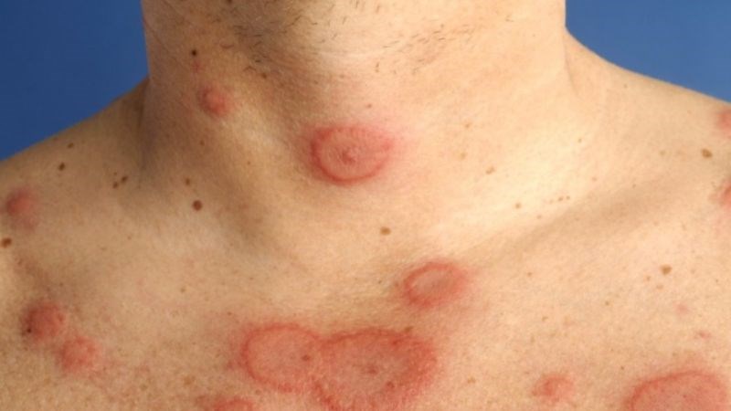 Bồ công anh mang lại hiệu quả trong việc điều trị viêm da như ghẻ, eczema