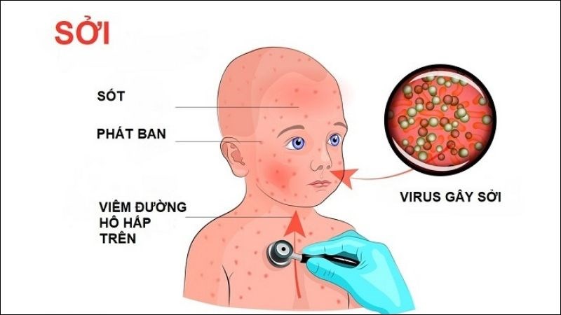 Bệnh sởi thường biểu hiện triệu chứng nặng nề ở trẻ không được bổ sung carotenoid