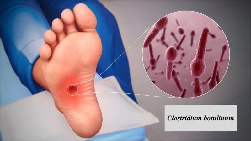 Người bệnh ngộ độc do bào tử Clostridium botulinum bám ở vết thương bẩn