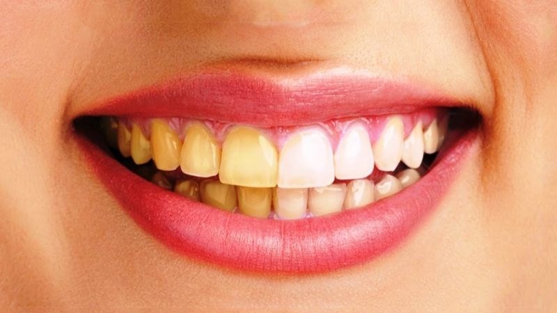 Cỏ ngọt có thể ngăn ngừa sâu răng và viêm lợi