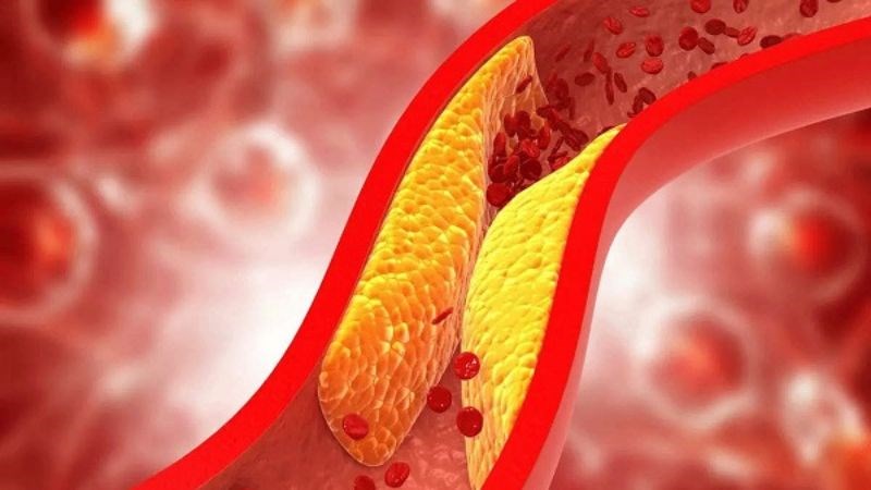 Nồng độ HDL Cholesterol quá cao trong máu có thể gây ra xơ vữa động mạch