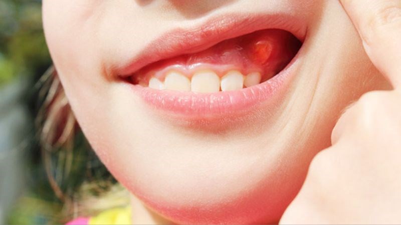 Các vấn đề viêm nướu, viêm lợi,... xảy ra thường xuyên khi bị tiểu đường
