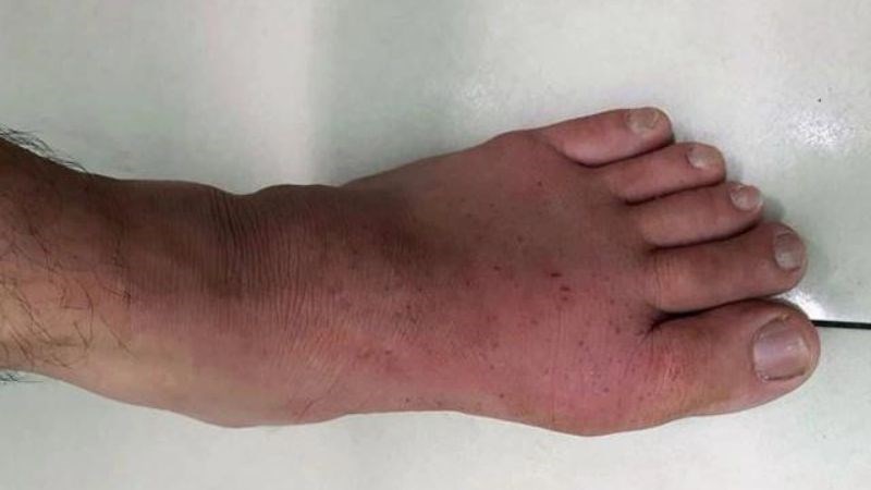 Đường fructose làm tăng acid uric trong máu dẫn tới bệnh gout