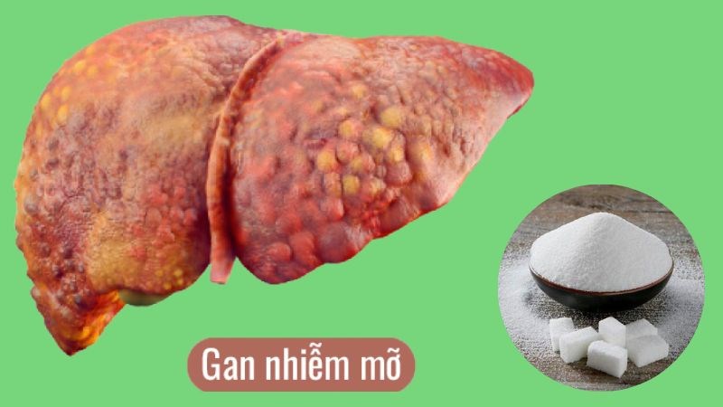 Fructose gây lắng đọng triglyceride dẫn tới gan nhiễm mỡ