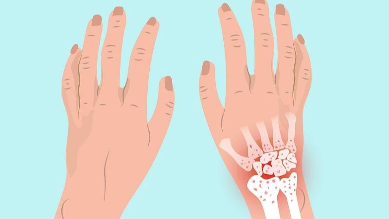 Long não giúp điều trị viêm khớp