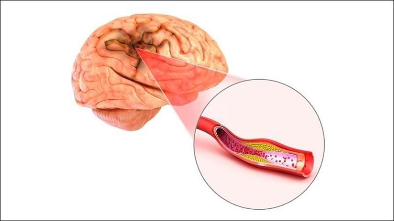 Việc sử dụng liều cao nhân sâm có thể gây viêm mạch máu não
