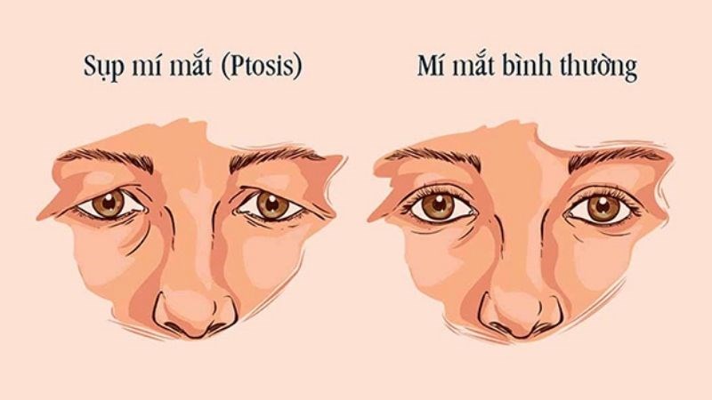 Sử dụng vông nem liều cao có thể gây sụp mí mắt