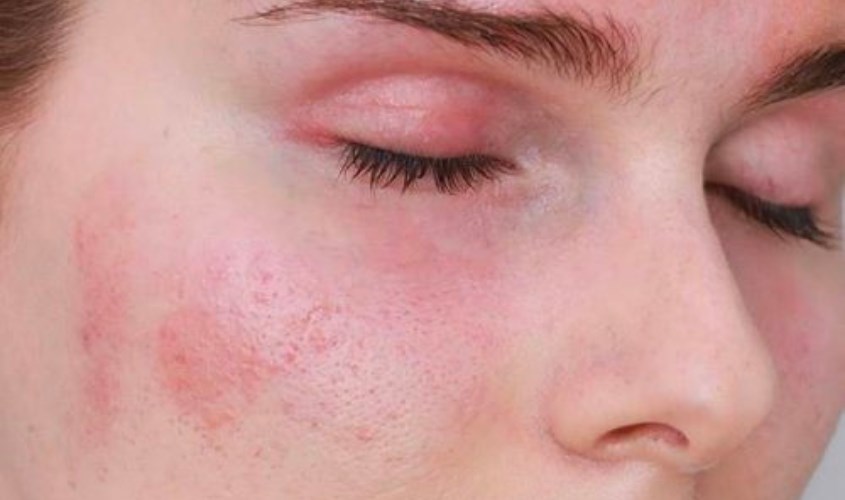 Có thể bị kích ứng nếu dùng kem đánh răng rửa mặt