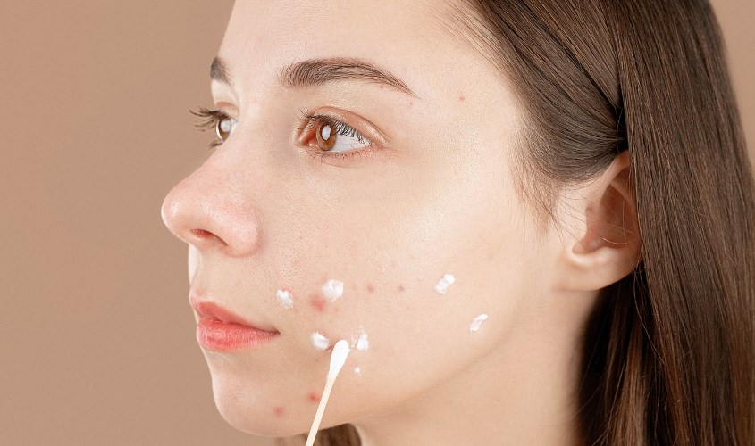 Chỉ bôi một lượng nhỏ kem đánh răng để trị mụn