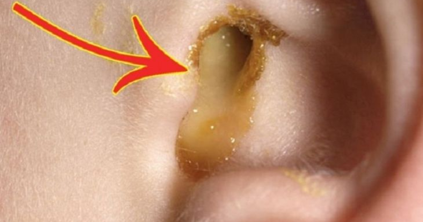 Vệ sinh tai không đúng cách có thể khiến trẻ bị viêm tai giữa