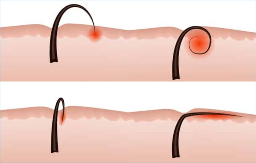 Dầu mù u trị mọc lông ngược Dầu mù u trị mọc lông ngược