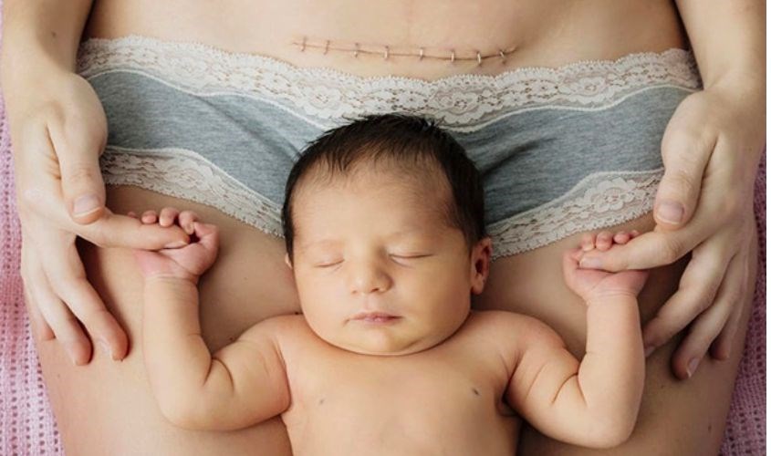 Phụ nữ sinh mổ khi tắm nên tránh để vết thương tiếp xúc với nước