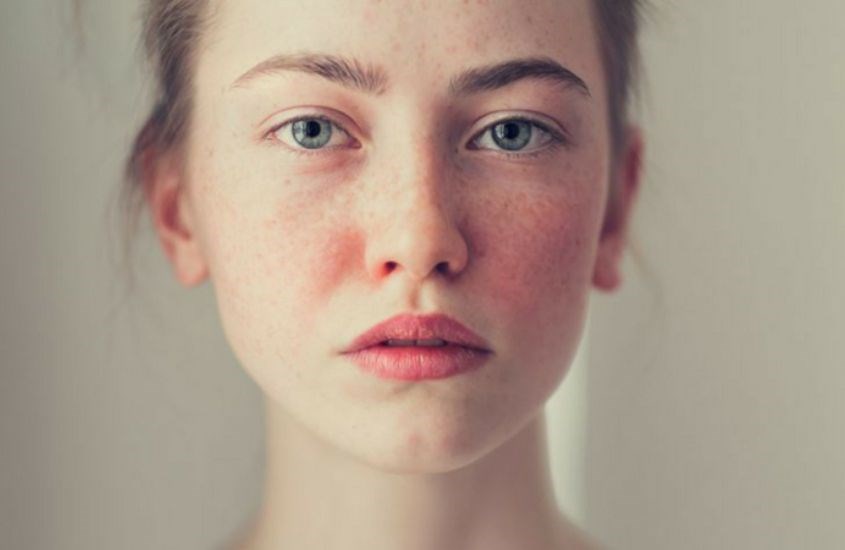 Ánh nắng mặt trời là nguyên nhân khiến da bạn bị sạm và tàn nhang