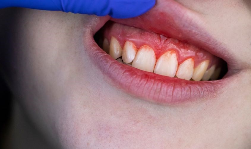 Đánh răng quá nhiều lần trong ngày có thể khiến nướu dễ bị tổn thương