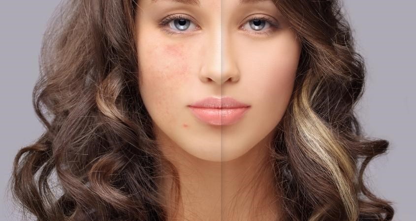 Hỗ trợ ngăn ngừa và trị mụn