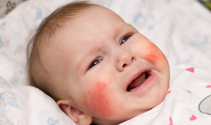 Thời tiết thay đổi cũng sẽ khiến da bé bị kích ứng Thời tiết thay đổi cũng sẽ khiến da bé bị kích ứng