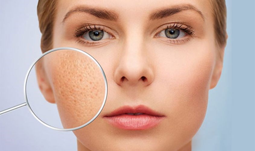 Dầu gấc giúp thu nhỏ lỗ chân lông Dầu gấc giúp thu nhỏ lỗ chân lông