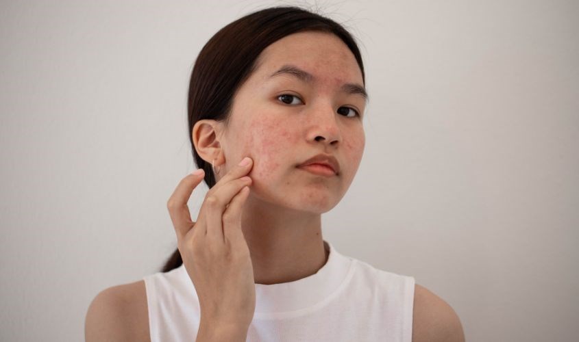 Da dầu sử dụng kem chống nắng hóa học dễ bị nổi mụn