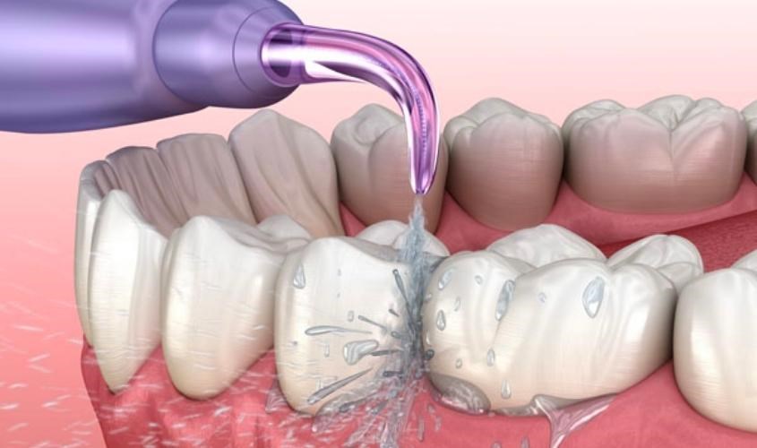 Máy tăm nước giúp khoang miệng của bạn được làm sạch mà không phải tổn thương đến bộ phận khác