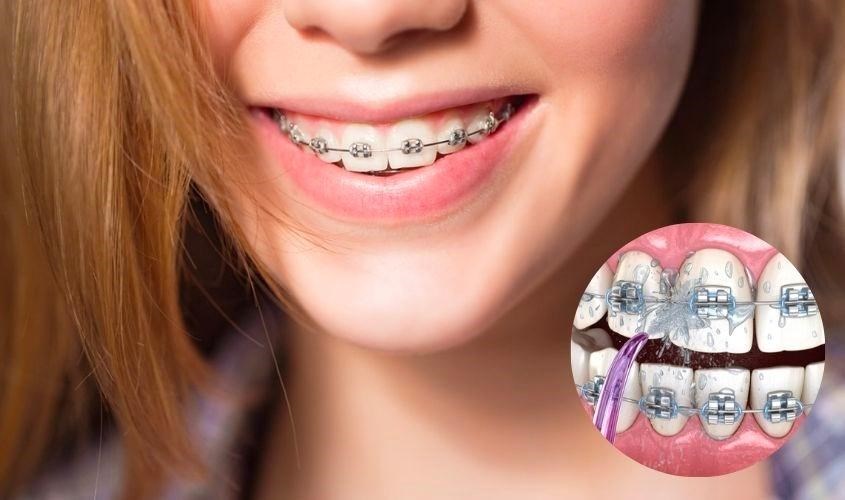 Máy tăm nước hỗ trợ rất nhiều cho người niềng răng
