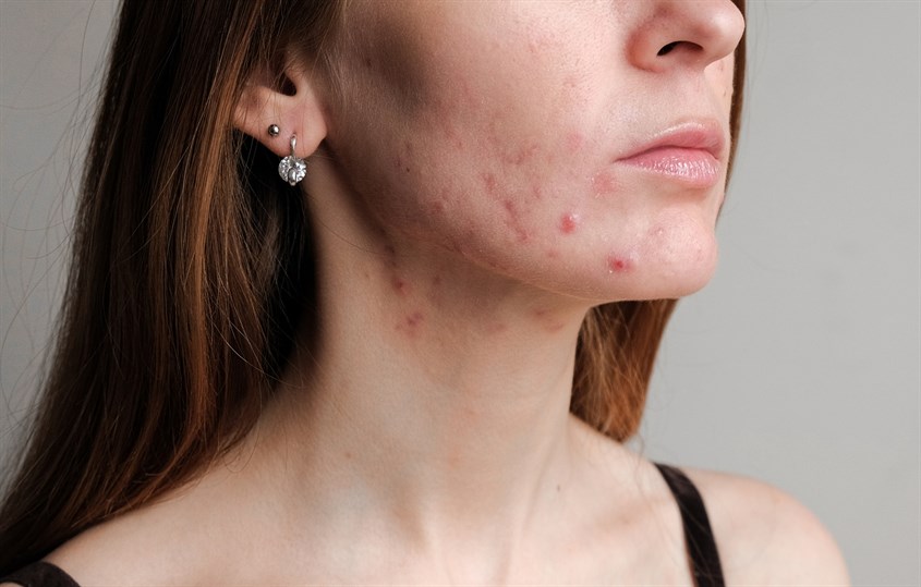 Một số tác hại khi sử dụng kem đánh răng điều trị mụn