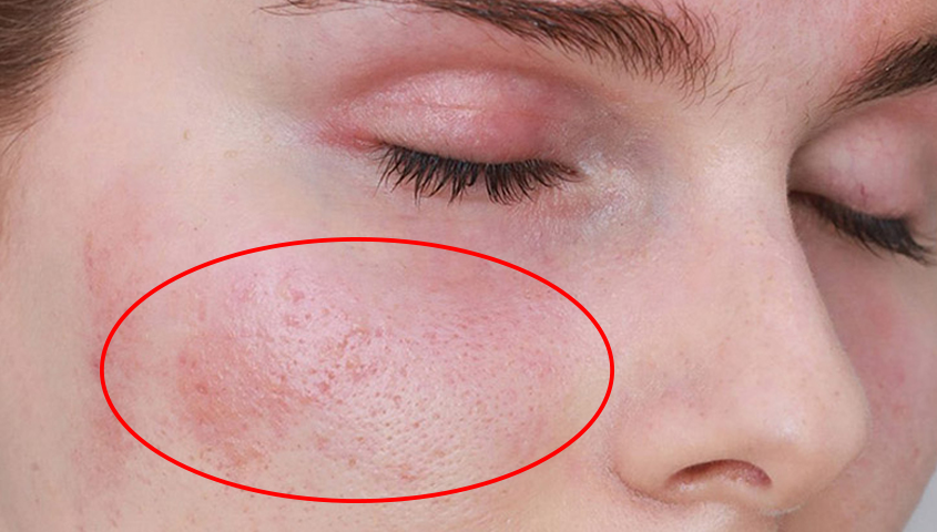 Ngưng sử dụng nếu da bị kích ứng[