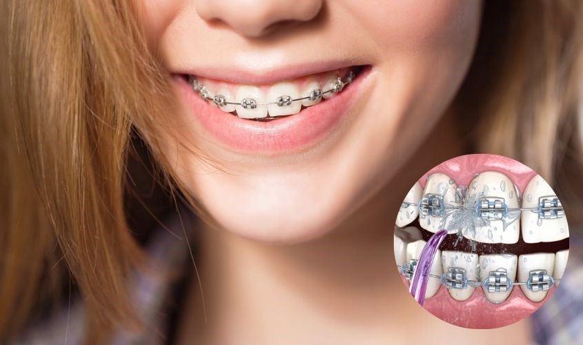 Lợi ích khi dùng máy tăm nước khi niềng răng