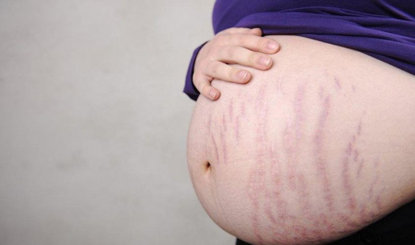 Tình trạng rạn da ở mẹ bầu