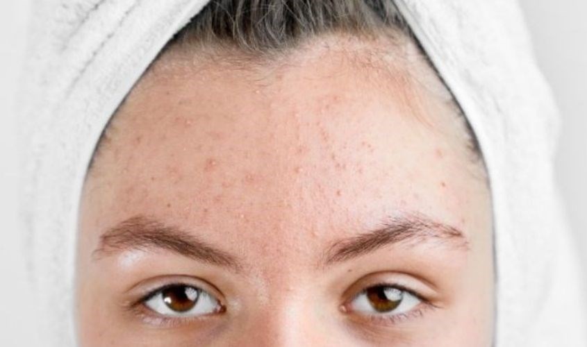 Trong quá trình mang thai, nhiều yếu tố tác động khiến mẹ bầu bị nổi mụn