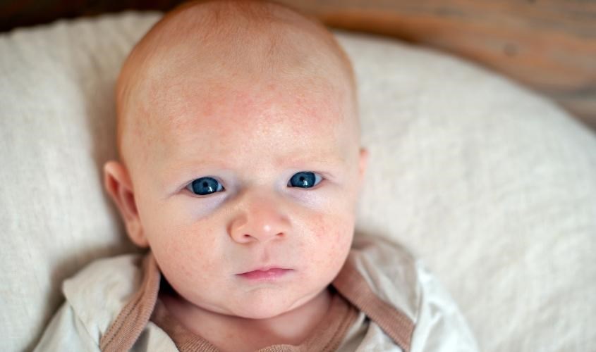 Xông tinh dầu liên tục có thể khiến bé dị ứng da